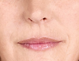 Sculptra after 01