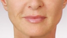 Juvederm after 01