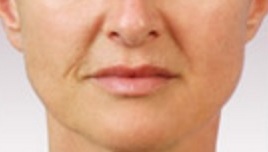 Juvederm before 01